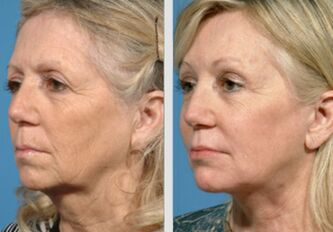 antes e depois do rejuvenescimento da pele com plasma