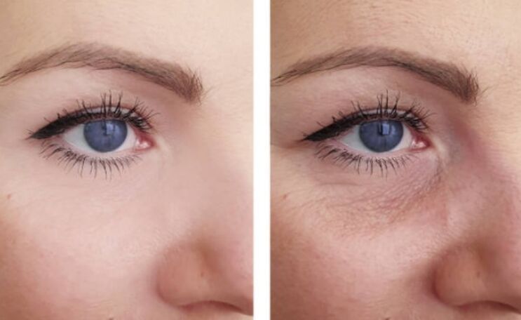 antes e depois do rejuvenescimento do plasma ao redor dos olhos