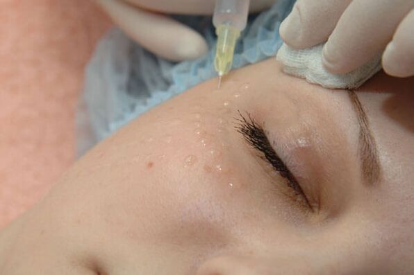 Mesoterapia - um método de injeção de rejuvenescimento da pele facial