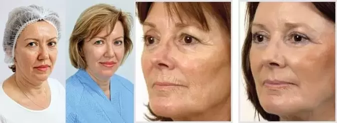 O resultado do rejuvenescimento da pele facial com laser é a redução das rugas