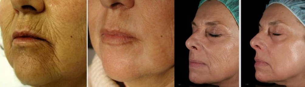 Pele facial antes e depois do procedimento de rejuvenescimento a laser