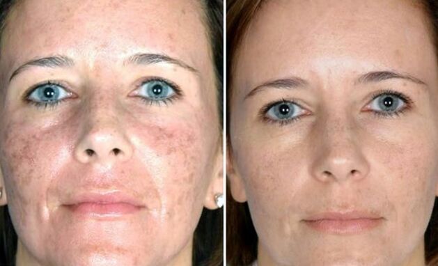 Rejuvenescimento a laser de campo - antes e depois