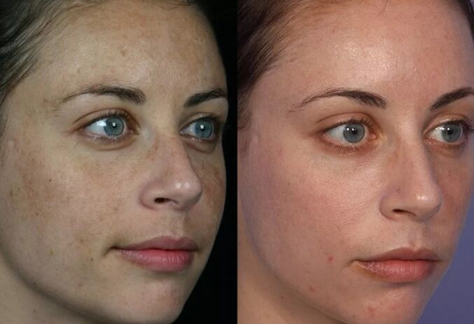 Tratamento de couro a laser