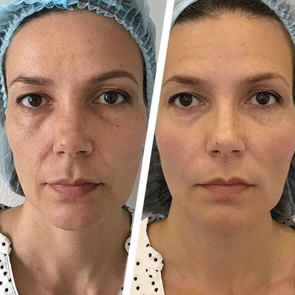 Rejuvenescimento a laser