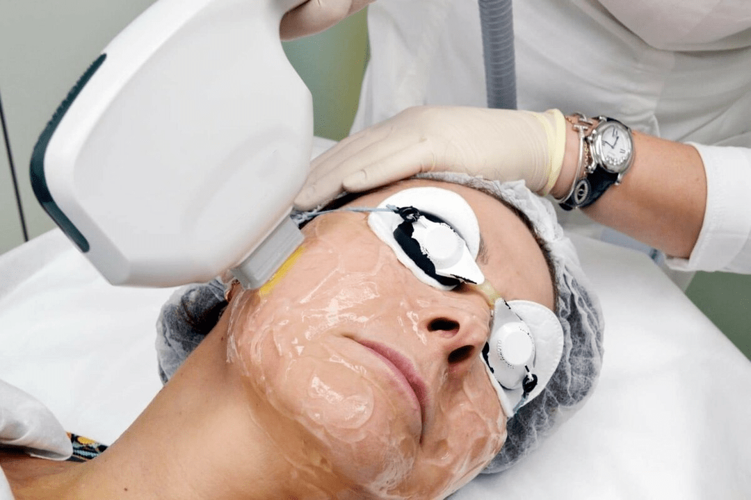 rejuvenescimento a laser para pele facial