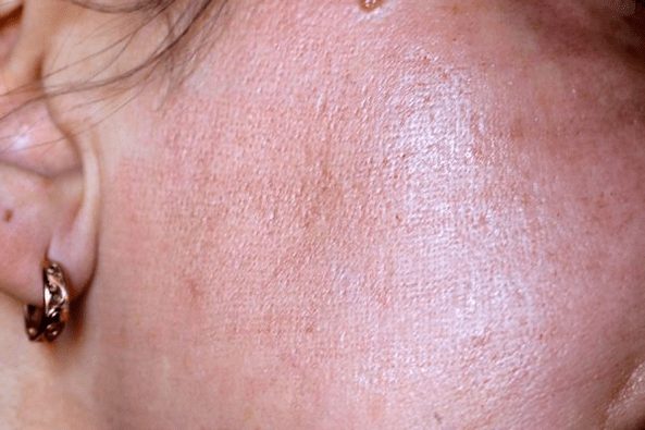 vermelhidão da pele após rejuvenescimento a laser