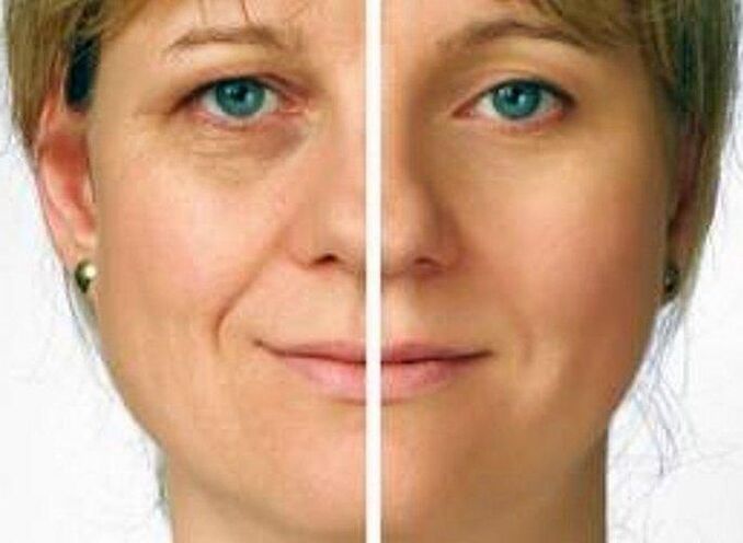 pele ao redor dos olhos antes e depois do rejuvenescimento